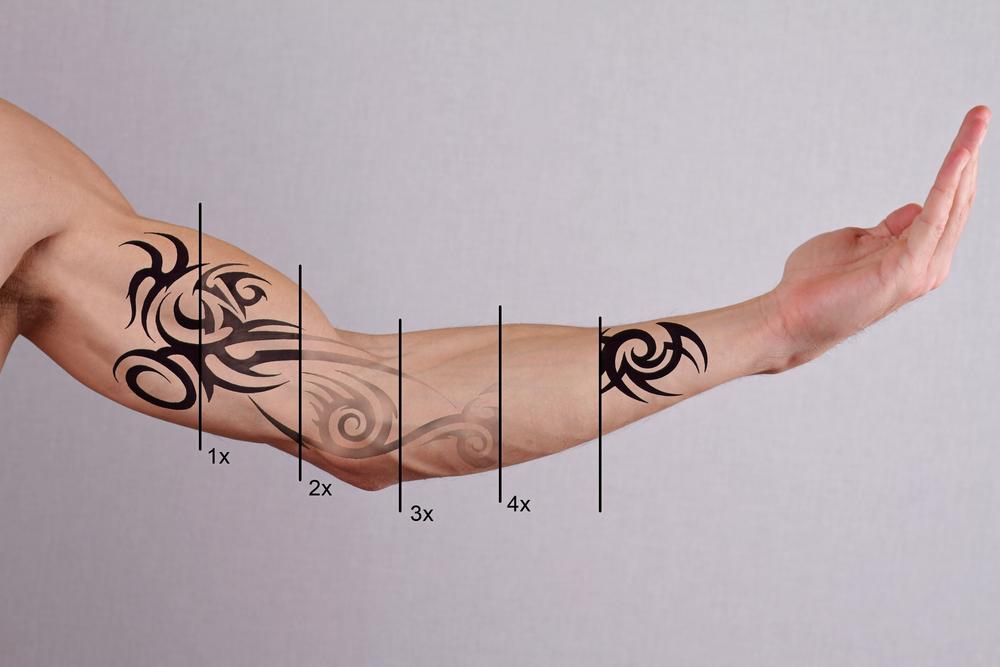 Tattoo šalinimo aparatai | Kosmetologinė įranga - AurelijosSPA