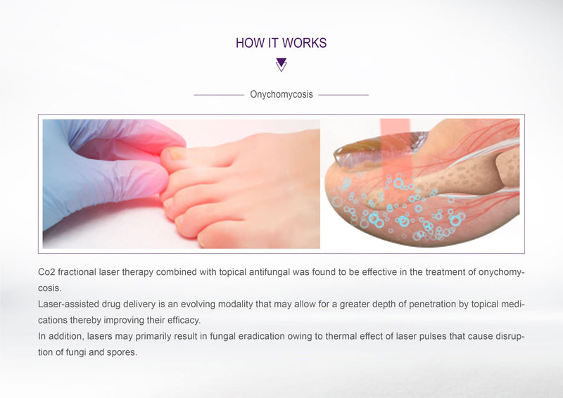 CO2 Fractional Laser Machine